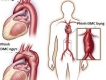 Cách nhận biết động mạch chủ bất thường