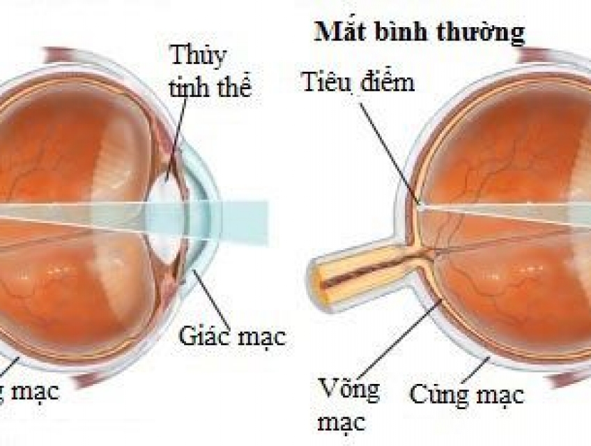 Tìm hiểu về sử dụng kính viễn, lão đúng cách?