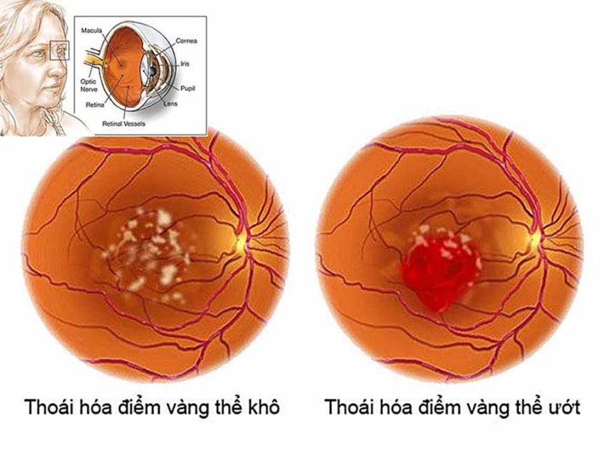 Người ngoài 60 tuổi cần chăm sóc mắt như thế nào?