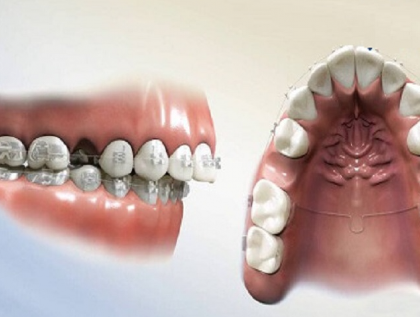 Nhổ răng khi niềng răng có tốt không?