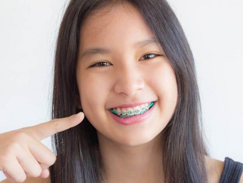 Độ tuổi nào niềng răng là hợp lý