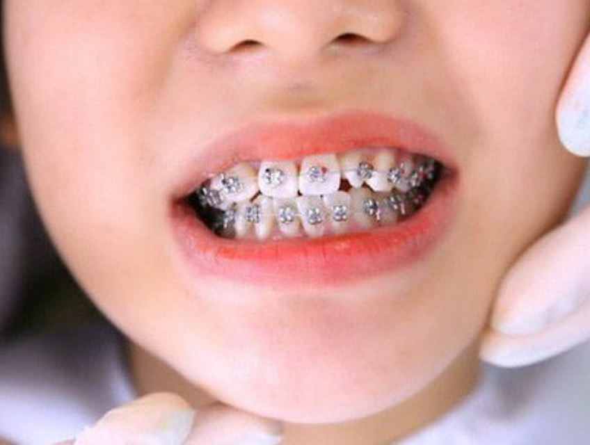 8 kinh nghiệm niềng răng cho trẻ mà bạn nên biết
