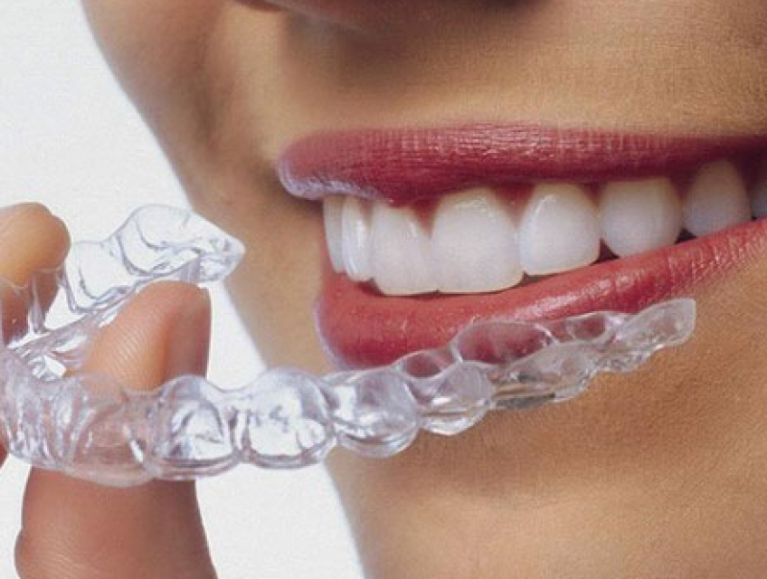 Niềng răng trong suốt có phải nhổ răng không?