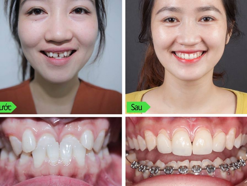 Niềng Răng Thẩm Mỹ