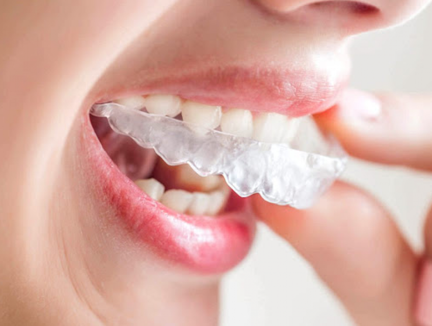 Có nên niềng răng trong suốt không? niềng răng trong suốt invisalign giá bao nhiêu?