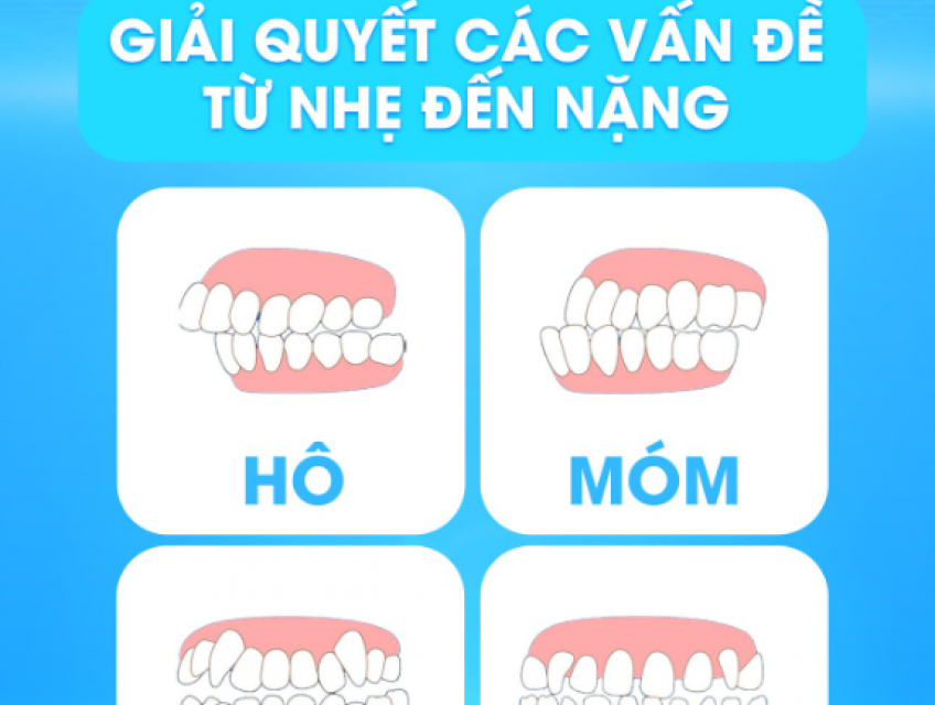 Niềng răng trong suốt invisalign là gì? Quy trình niềng invisalign
