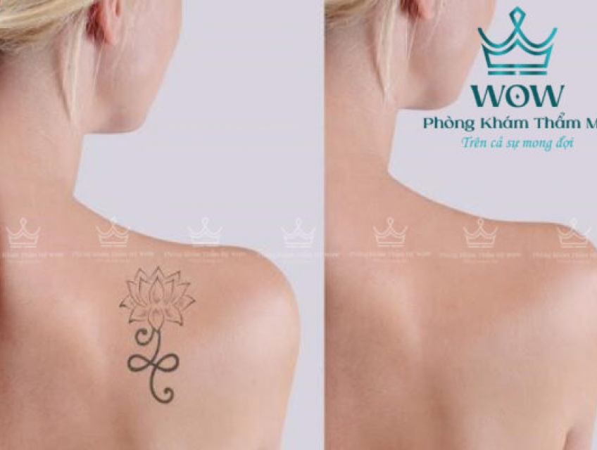 Phương pháp xóa xăm bằng Laser