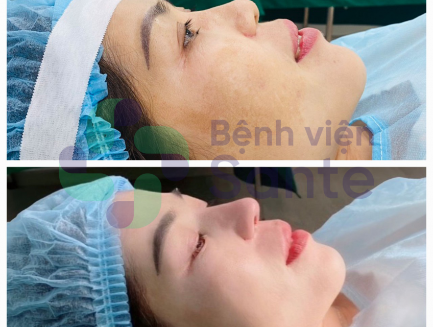 Phẫu thuật nâng mũi là gì? Bệnh viện chuyên khoa phẫu thuật nâng mũi