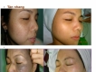 spa trị nám tàn nhang tại quận 6 tphcm  /Trị nám ở quận 6 đâu tốt TPHCM