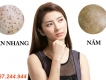 Trị nám dứt điểm chỉ trong 5 tuần - kem trị nám Kami skin
