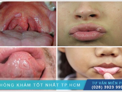 Bạn có biết bệnh sùi mào gà ở miệng giai đoạn đầu ra sao không ?