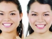 Phương pháp xóa nếp nhăn làm đẹp khuôn mặt
