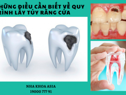 Những điều cần biết về quy trình lấy tủy răng cửa