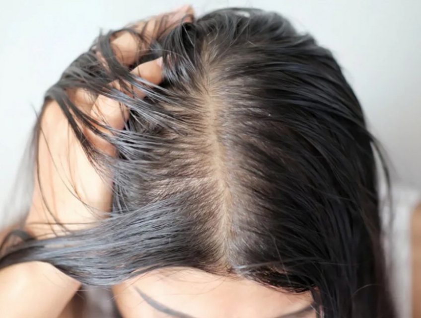 "Kiểm Soát Dầu Hiệu Quả Của Tóc: Sản Phẩm và Phương Pháp Điều Trị"