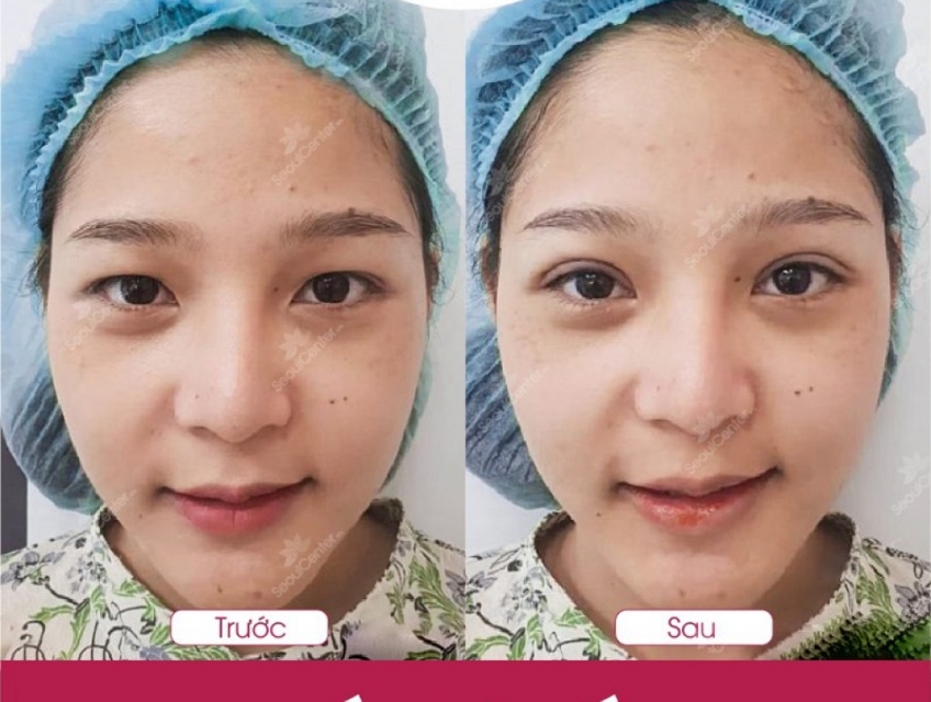 "Lột xác" ngoạn mục với cắt mí: Bao lâu để bạn tự tin tỏa sáng?