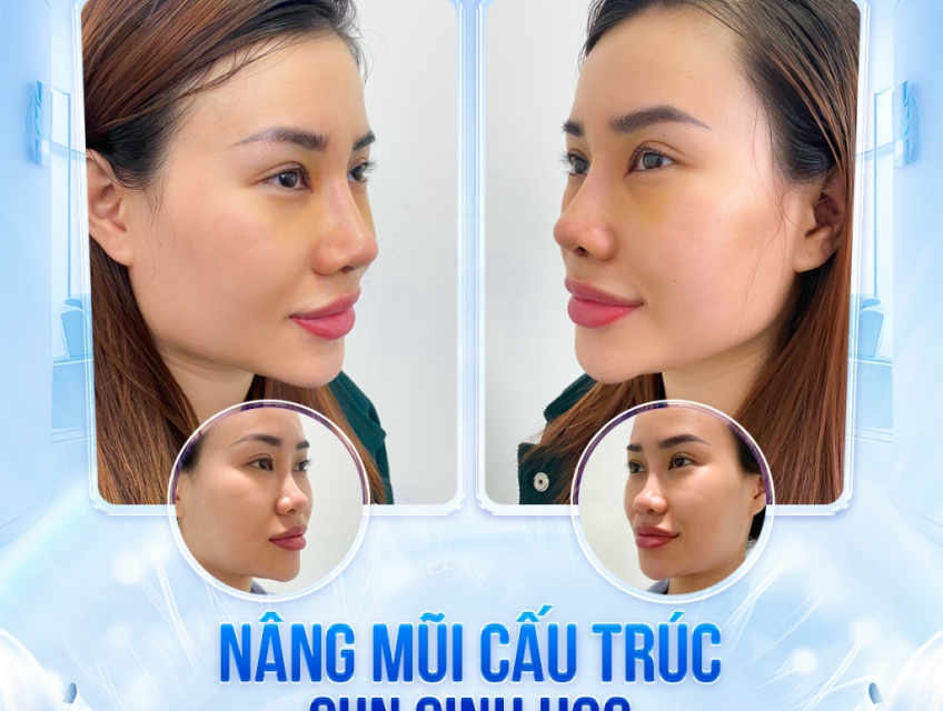 Dáng mũi phổ biến