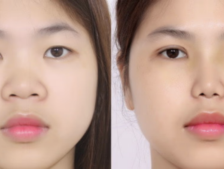 Các Loại Mí Mắt Và Phương Pháp Thẩm Mỹ Phù Hợp