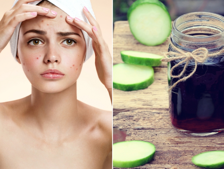 Giảm mụn nhọt hiệu quả từ nước uống bí đao khô tại nhà