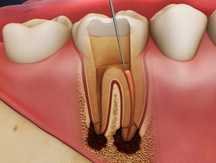Các bệnh lý về răng và cách điều trị bằng kem đánh răng VSMILE