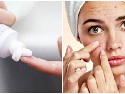 CÁCH  TRỊ MỤN BỌC ĐƠN GIẢN VÀ HIỆU QUẢ TẠI NHÀ