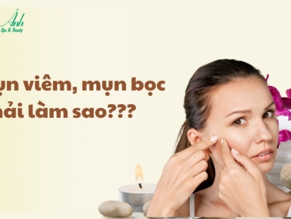Cách Trị Mụn Viêm Ở Má Hiệu Quả Cao