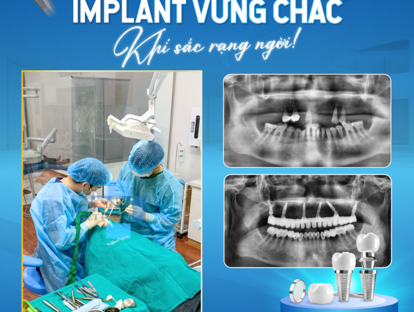 Thời gian trồng răng implant: Bao lâu thì hoàn tất?