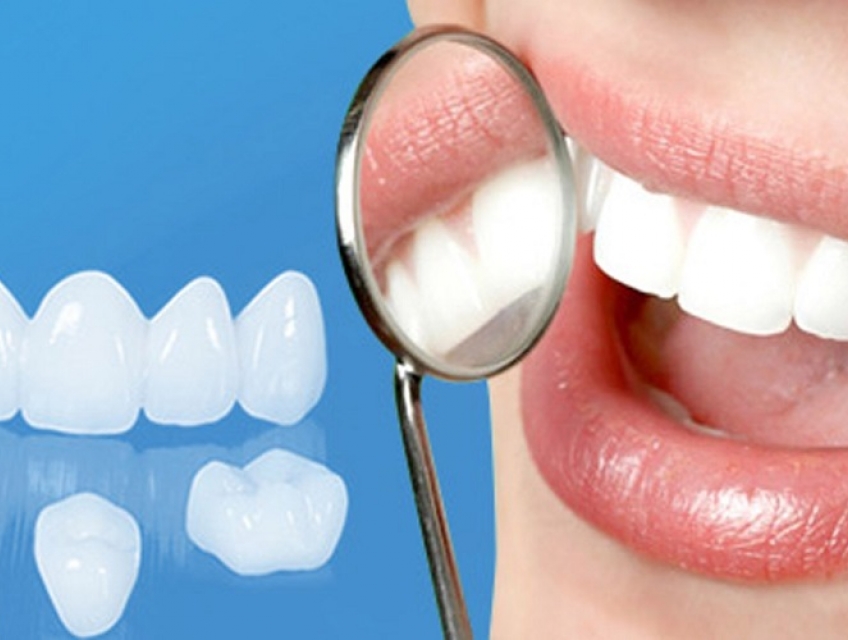 Những điều cần biết về chi phí lắp răng toàn sứ