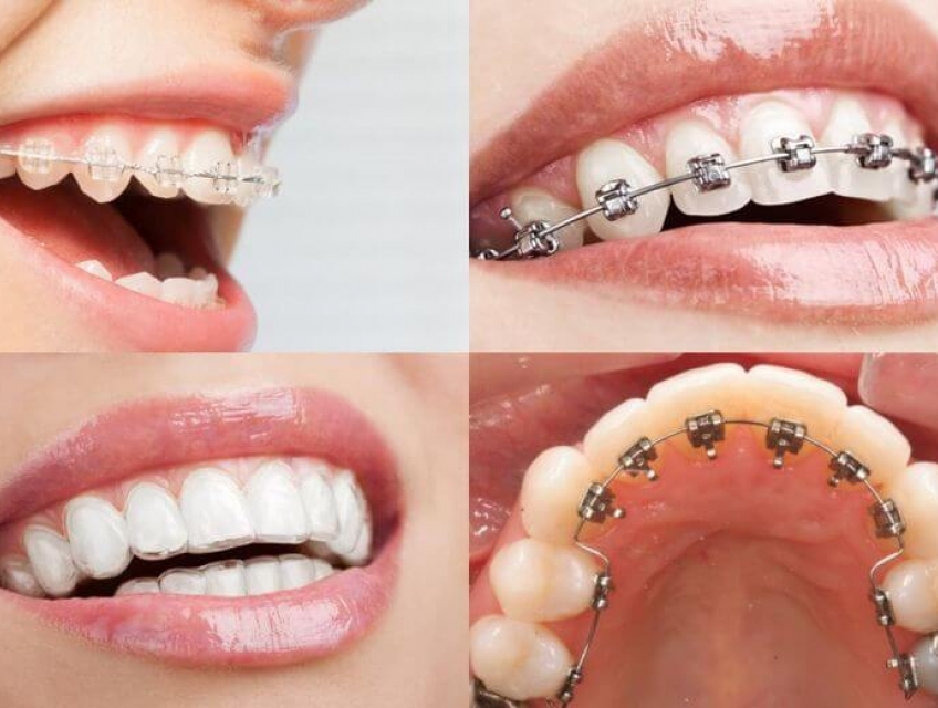 Giá Niềng Răng 1 Hàm: Những Điều Cần Biết