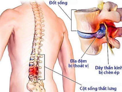 Tự điều trị thoát vị đĩa đệm hiệu quả bằng phương pháp con lăn doctor