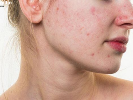 Ăn gì để mát gan hết mụn? Top 9 thực phẩm hàng đầu giải độc gan bạn kh