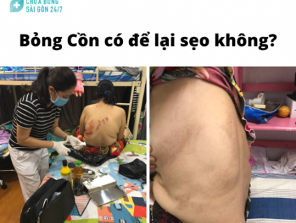 Bỏng cồn có nguy hiểm không