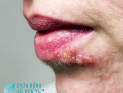 Bệnh zona thần kinh ở môi trông như thế nào?