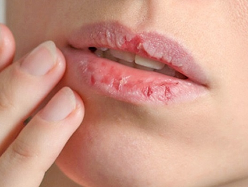 Phun Môi Kiêng Trứng Bao Lâu: Dùng Công Nghệ Laser Có Cần Kiêng Trứng?