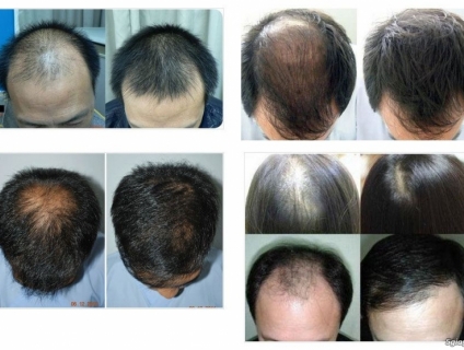 Tinh chất gừng tươi Keing Pure – Cách làm tóc mau dài nhanh nhất