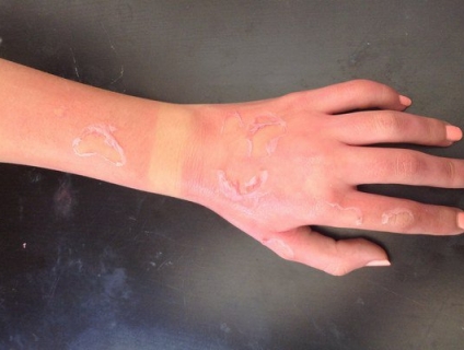 Các cấp độ của bỏng