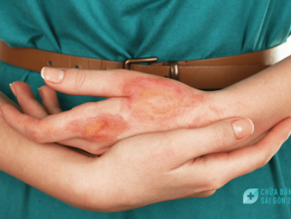 Những điều cần biết về điều trị bỏng