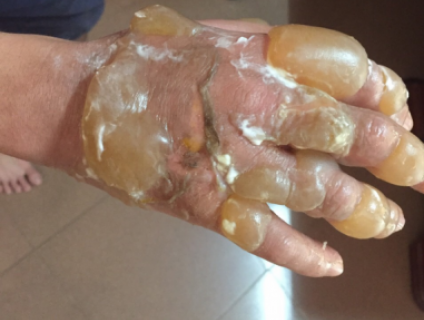 Bỏng nước sôi và cách xử lý