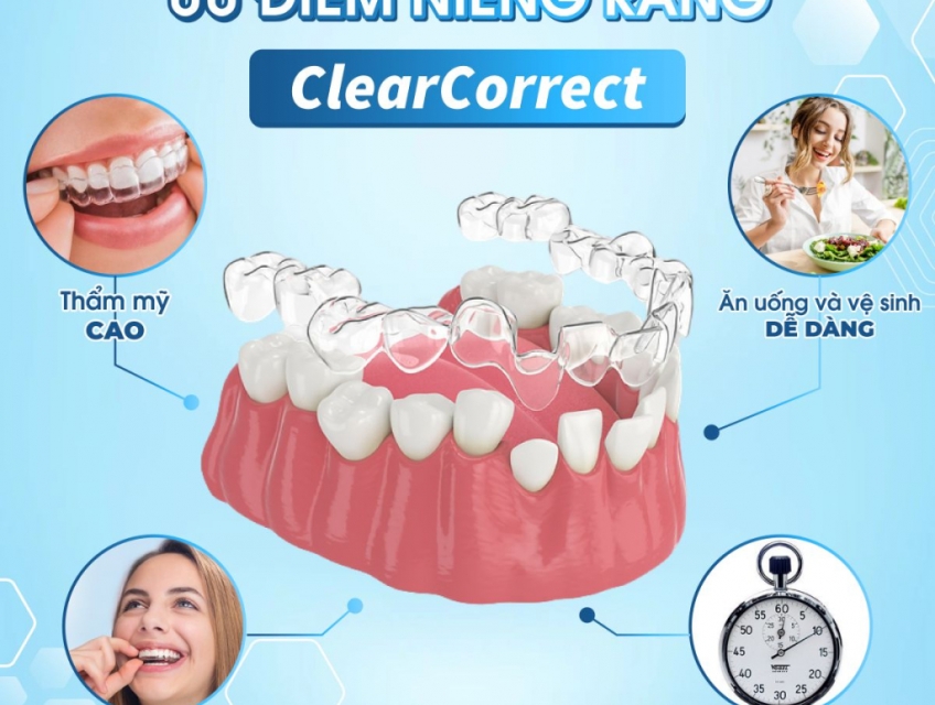 Niềng Răng ClearCorrect: Giải Pháp Hoàn Hảo Cho Nụ Cười Hoàn Mỹ