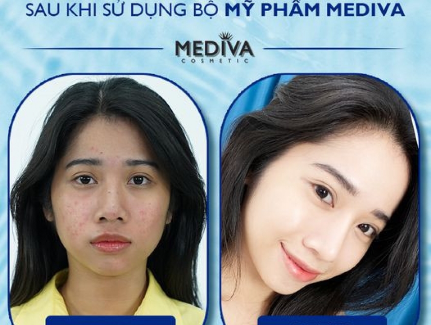 Tế bào gốc Mediva Bio Placenta Solution