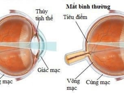 VIỄN THỊ VÀ LÃO THỊ KHÁC NHAU NHƯ THẾ NÀO, CÁCH CHỌN KÍNH PHÙ HỢP