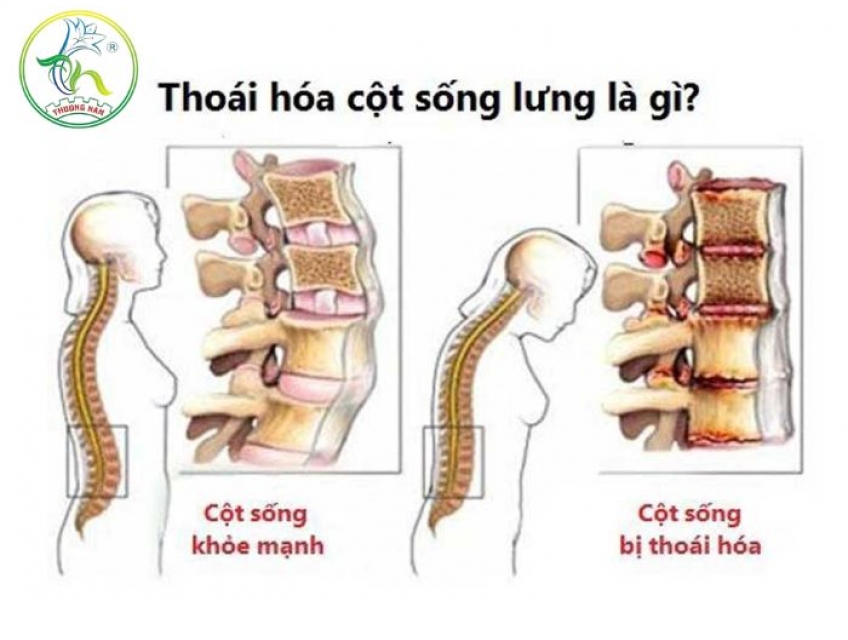 Thoái Hóa Cột Sống Thắt Lưng: Triệu Chứng Và Phương Pháp Điều Trị Hiệu
