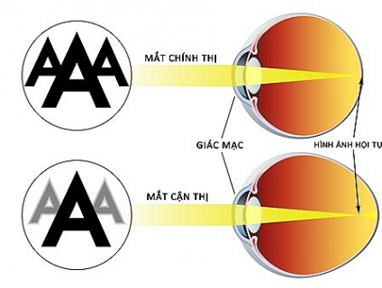 BỊ CẬN THỊ: MUA GỌNG KÍNH Ở ĐÂU UY TÍN NHẤT TẠI HÀ NỘI?