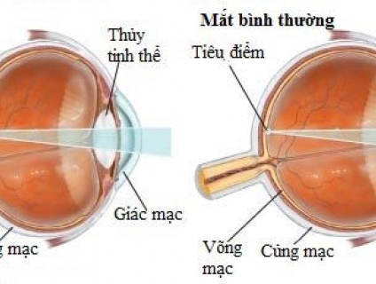 CÁCH SỬ DỤNG KÍNH VIỄN, LÃO ĐÚNG CÁCH