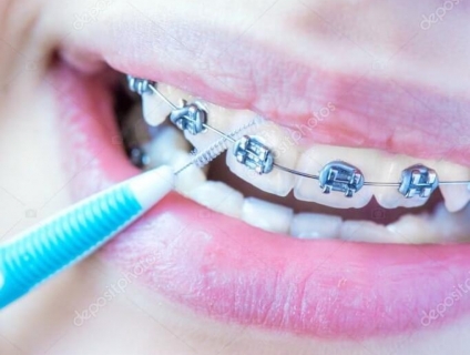 Tăm răng INOX vệ sinh khe kẽ răng, phù hợp cho những bạn niềng răng