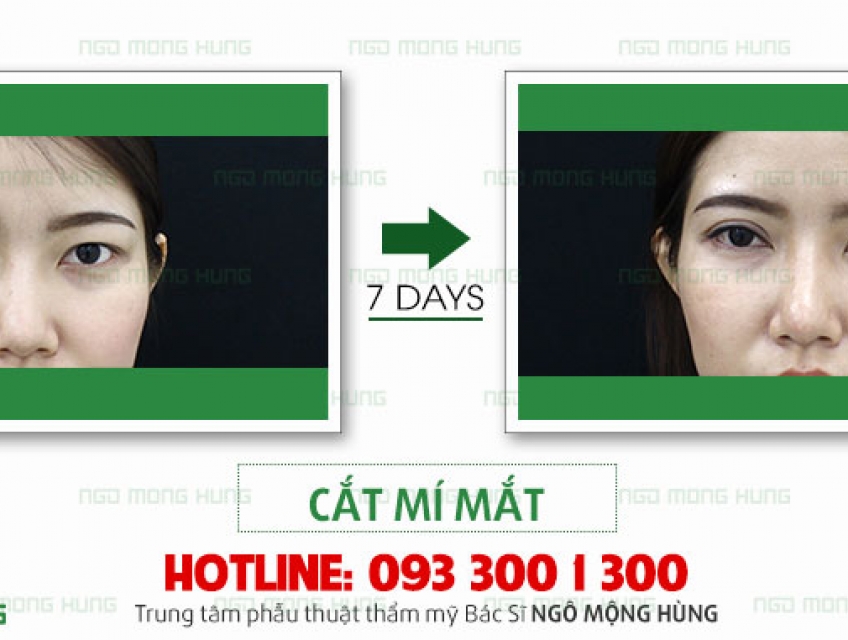 Chi phí cắt mí mắt hàn quốc bao nhiêu tiền?
