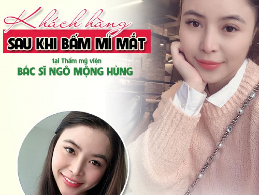 Giải đáp thắc mắc - Bấm mí sau bao lâu thì đẹp?