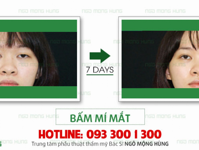 Nên chọn cắt mí hay bấm mí tốt hơn?