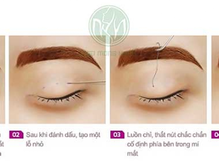 Bấm mí bao lâu thì đẹp| Thẩm mỹ viện Ngô Mộng Hùng