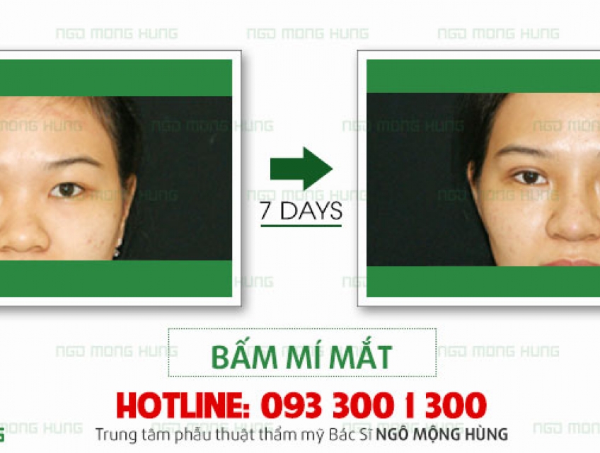 Bấm mí có phải kiêng gì không? Những điều bạn nên biết