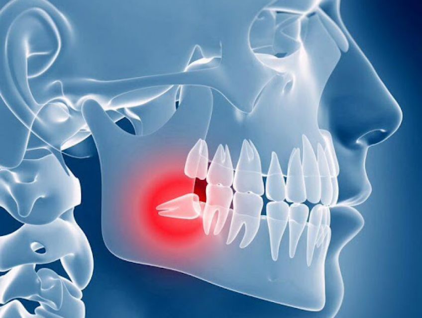 Nhổ răng khôn là gì? Có nhất thiết phải nhổ răng khôn không?